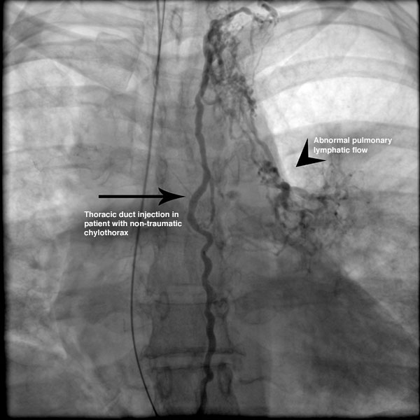 Penn Interventional Radiology MRI showing contrast dye injection in thoracic duct